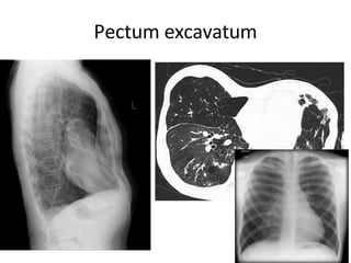 Pectum excavatum
 