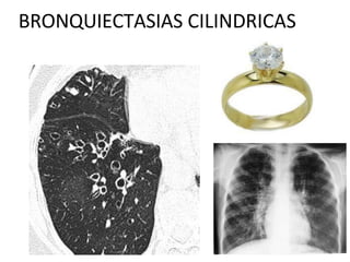 BRONQUIECTASIAS CILINDRICAS
 