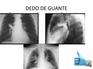 DEDO DE GUANTE
 