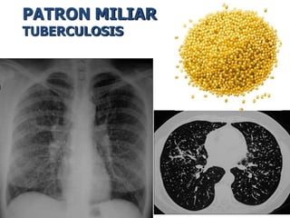 PATRON MILIAR
TUBERCULOSIS
 