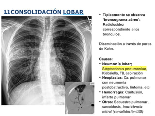 iDESIGN
by HiSlide.io
• Típicamente se observa
‘broncograma aéreo’:
Radiolucidez
correspondiente a los
bronquios.
Diseminación a través de poros
de Kohn.
Causas:
• Neumonía lobar;
Steptococcus pneumoniae,
Klebsiella, TB, aspiración
• Neoplasias: Ca. pulmonar
con neumonía
postobstructiva, linfoma, etc
• Hemorragia: Contusión,
infarto pulmonar
• Otros: Secuestro pulmonar,
sarcoidosis, insuﬁciencia
mitral (consolidación LSD)
1.1CONSOLIDACIÓN LOBAR
 