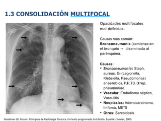 iDESIGN
by HiSlide.io
1.3 CONSOLIDACIÓN MULTIFOCAL
Opacidades multifocales
mal deﬁnidas.
Causas más común:
Bronconeumonía (comienza en
el bronquio → diseminada al
parénquima.
Causas:
• Bronconeumonía: Staph.
aureus, G- (Legionella,
Klebsiella, Pseudomonas)
anaerobios, PJ
P, TB. Strep.
pneumoniae,
• Vascular: Embolismo séptico,
Vasculitis
• Neoplasias: Adenocarcinoma,
linfoma, METS
• Otros: Sarcoidosis
Goodman LR. Felson. Principios de Radiología Torácica. Un texto programado.3a Edición. España: Elsevier; 2009.
 