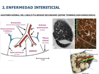 iDESIGN
by HiSlide.io
50
2. ENFERMEDAD INTERSTICIAL
ANATOMÍA NORMAL DEL LOBULO PULMONAR SECUNDARIO (DEFINE TERMINOLOGÍA RADIOLÓGICA)
Bronquiolos
(grosor de la pared 0.15mm) Arterias
pulmonares
(1mm)
Pleura
viceral
(0.1mm)
Septo interlobular
(0.1mm)
Venas pulmonares
+ Linfáticos
(0.5mm)
ACINOS
 