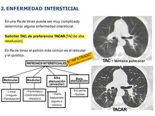 iDESIGN
by HiSlide.io
TAC - Ventana pulmonar
TACAR
En una Rx de tórax puede ser muy complicado
determinar alguna enfermedad intersticial.
Solicitar TAC,de preferencia TACAR(TACde alta
resolución).
En Rx de tórax el patrón más común es el reticular
y el quístico.
PATRONESINTERSTICIALES
Reticular Nodular
- Lineal
- Irregular
- Panalización
- Perilinfático
- Centrolobulillar
- Aleatorio
Alta
atenuación
(alveolar)
- Vidrio
deslustrado
(agudo o
crónico)
Baja
atenuación
- Enﬁsema
- Quistes
2. ENFERMEDAD INTERSTICIAL
 