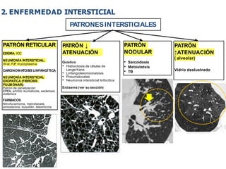 iDESIGN
by HiSlide.io
2. ENFERMEDAD INTERSTICIAL
PATRONESINTERSTICIALES
PATRÓN RETICULAR
EDEMA: ICC
NEUMONÍA INTERSTICIAL:
Viral, PJ
P
, mycoplasma
CARCINOMATOSIS LINFANGÍTICA
NEUMONÍA INTERSTICIAL
IDIOPATÍCA (FIBROSIS
PULMONAR):
Patrón de panalización
EPIDs, artritis reumatoide, esclerosis
sistémica
FÁRMACOS
Nitrofurantoína, metrotexate,
amiodarona, busulfán, bleomicina
PATRÓN ↓
ATENUACIÓN
Quístico
• Histiocitosis de células de
Langerhans
• Linfangioleiomiomatosis
• Pneumatoceles
• Neumonía intersticial linfocítica
Enﬁsema (ver su sección)
PATRÓN
NODULAR
• Sarcoidosis
• Metástatsis
• TB
PATRÓN
↑ATENUACIÓN
( alveolar)
Vidrio deslustrado
 
