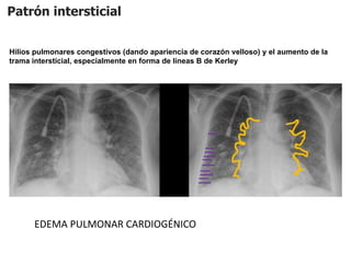 Patrón intersticial
Hilios pulmonares congestivos (dando apariencia de corazón velloso) y el aumento de la
trama intersticial, especialmente en forma de líneas B de Kerley
EDEMA PULMONAR CARDIOGÉNICO
 
