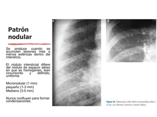 Patrón
nodular
Se produce cuando se
acumulan lesiones más o
menos esféricas dentro del
intersticio.
El nódulo intersticial difiere
del nódulo de espacio aéreo
en que es homogéneo, bien
circunscrito y definido,
uniforme.
Micronodular (1 mm)
pequeño (1-3 mm)
Mediano (3-5 mm)
Nunca confluyen para formar
condensaciones.
 