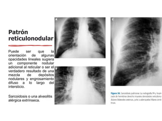 Patrón
reticulonodular
Puede ser que la
orientación de algunas
opacidades lineales sugiera
un componente nodular
adicional al reticular o ser el
verdadero resultado de una
mezcla de depósitos
nodulares y engrosamiento
difuso a lo largo del
intersticio.
Sarcoidosis o una alveolitis
alérgica extrínseca.
 