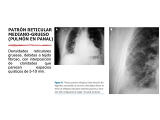 PATRÓN RETICULAR
MEDIANO-GRUESO
(PULMÓN EN PANAL)
Densidades reticulares
gruesas, debidas a tejido
fibroso, con interposición
de claridades que
parecen espacios
quísticos de 5-10 mm.
 