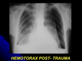 HEMOTORAX POST- TRAUMA   