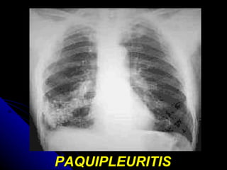 PAQUIPLEURITIS 