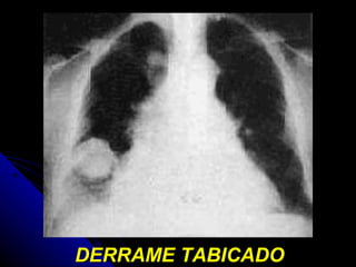 DERRAME TABICADO 