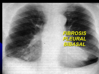 FIBROSIS PLEURAL BIBASAL 
