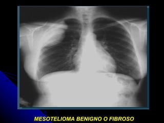 MESOTELIOMA BENIGNO O FIBROSO 