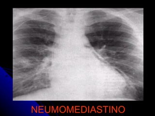 NEUMOMEDIASTINO 