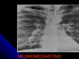 NEUMOMEDIASTINO 