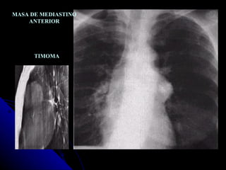MASA DE MEDIASTINO ANTERIOR TIMOMA 