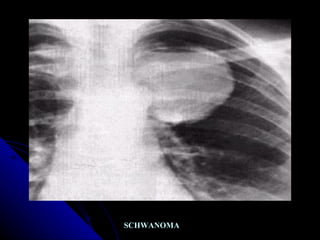 SCHWANOMA 