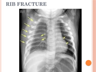 Radiological Anatomy for bone fracture.pptx