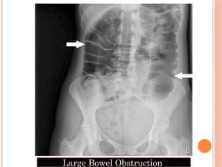 Radiological Anatomy for bone fracture.pptx
