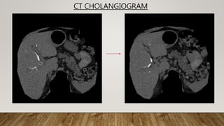 Radiological anatomy of biliary system | PPTX