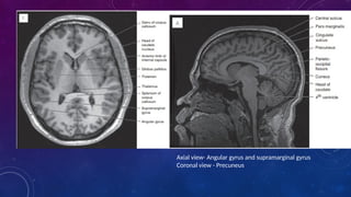 RADIOLOGICAL ANATOMY OF BRAIN.pptx………….. | PPTX