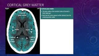 RADIOLOGICAL ANATOMY OF BRAIN.pptx………….. | PPTX