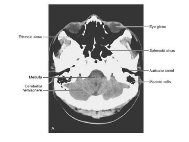 CT and MRI anatomy of brain | PDF | Brain and Nervous System Disorders ...