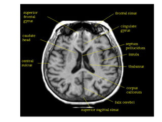 CT and MRI anatomy of brain | PDF