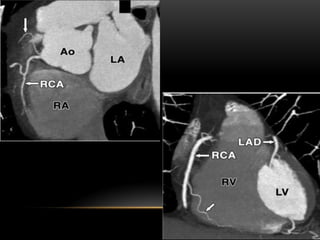 Radiological anatomy of coronary artery and its variations copy copy.pptx