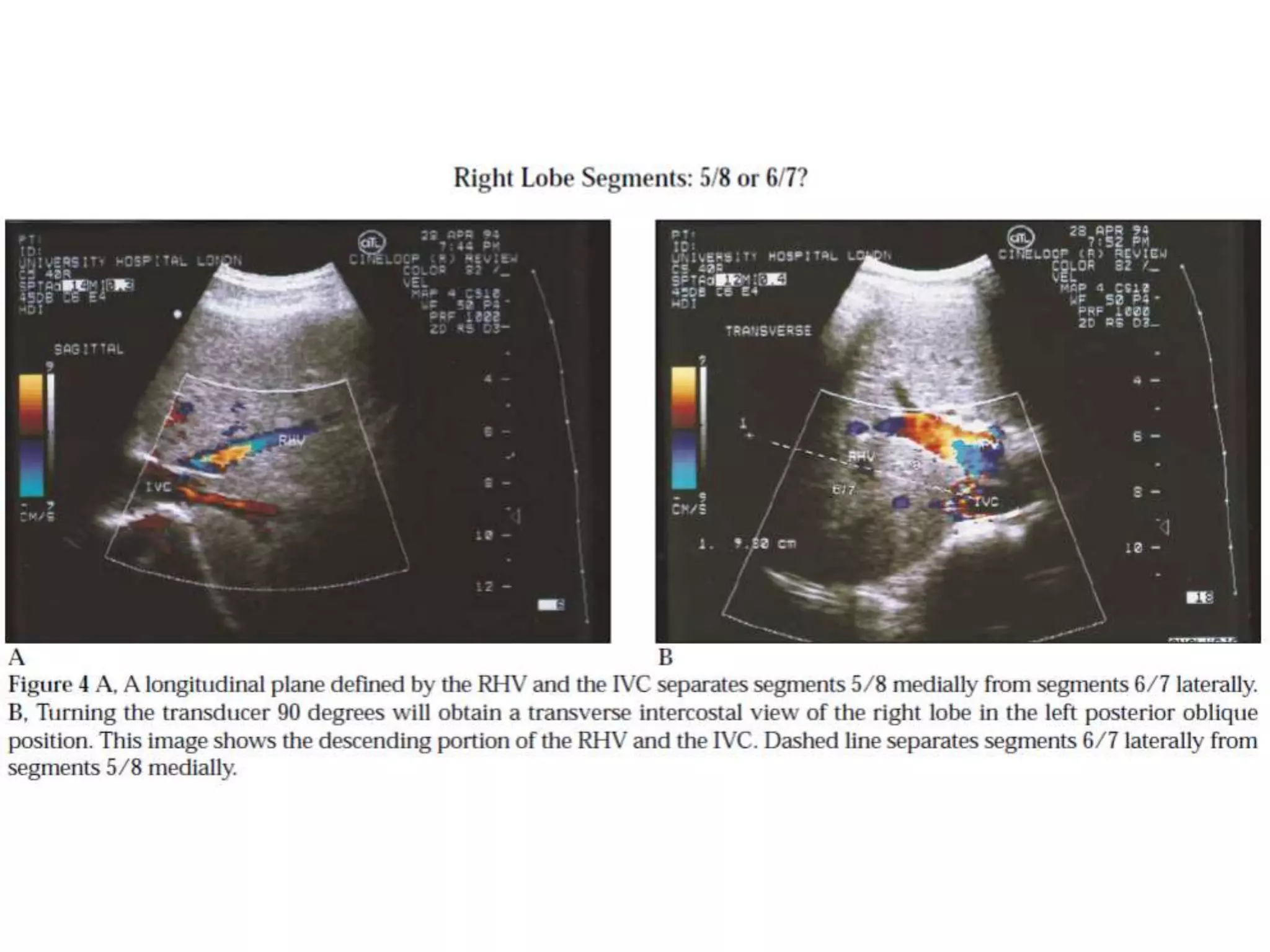 Segmental Anatomy of Liver and its Radiological Correlation | PPTX