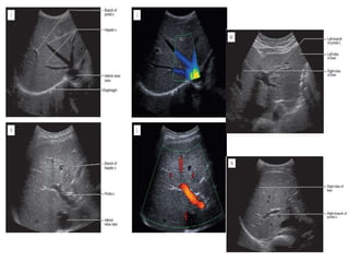 Segmental Anatomy of Liver and its Radiological Correlation | PPTX