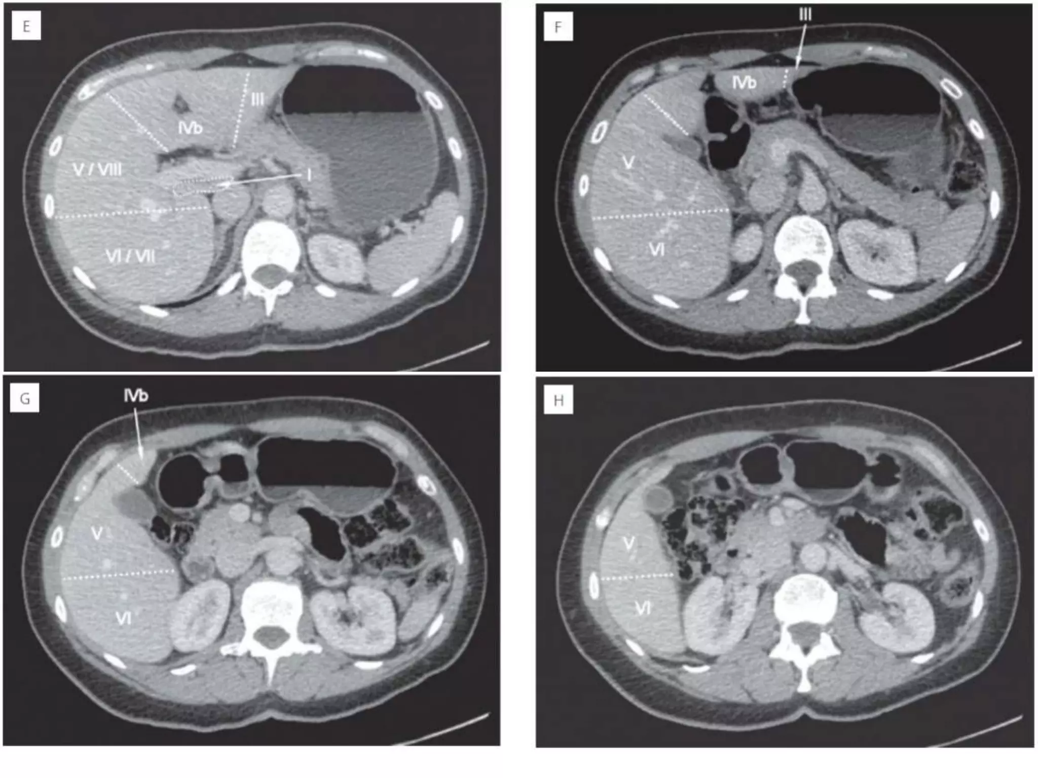 Radiological anatomy of liver segments