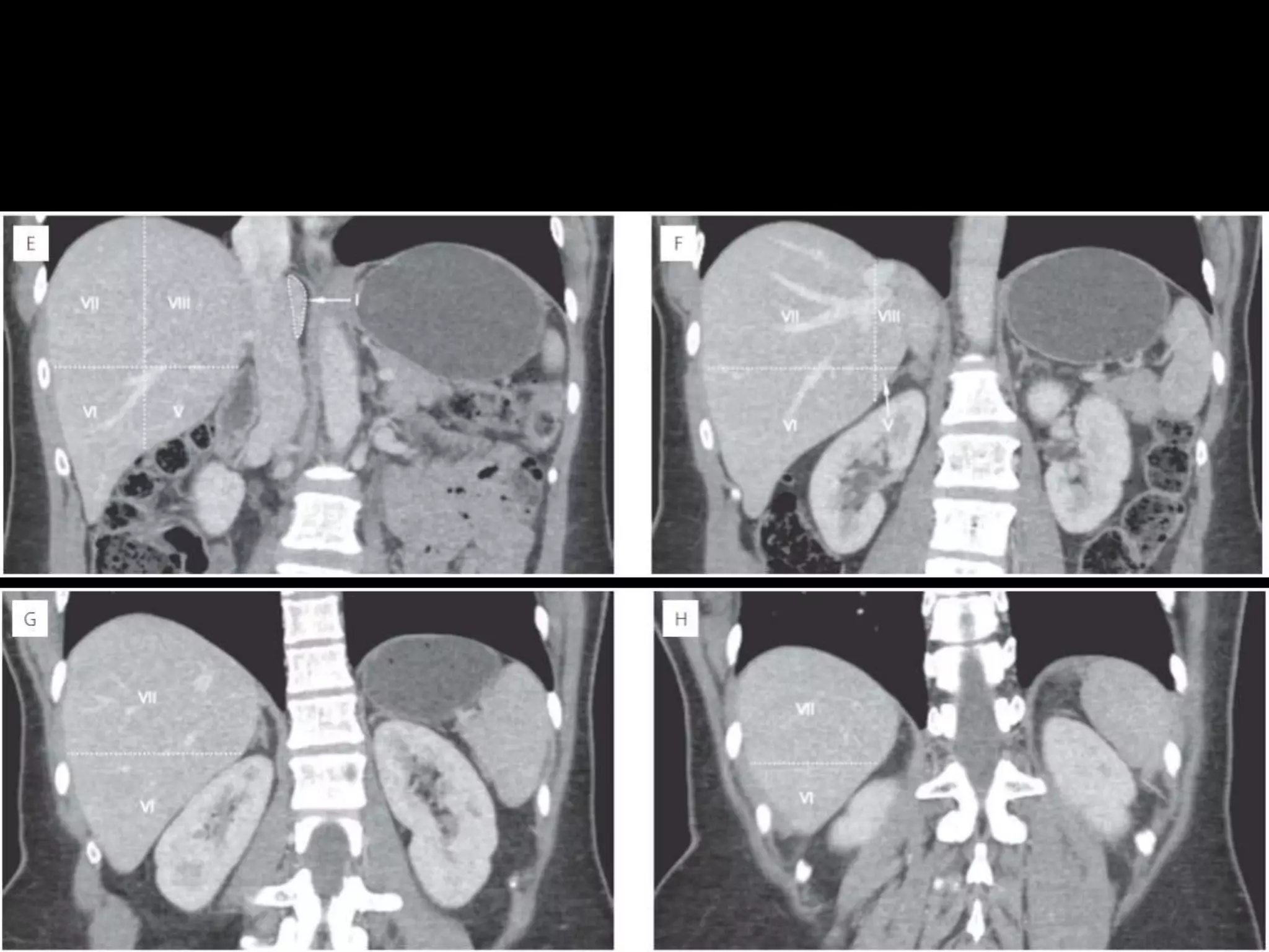 Radiological anatomy of liver segments
