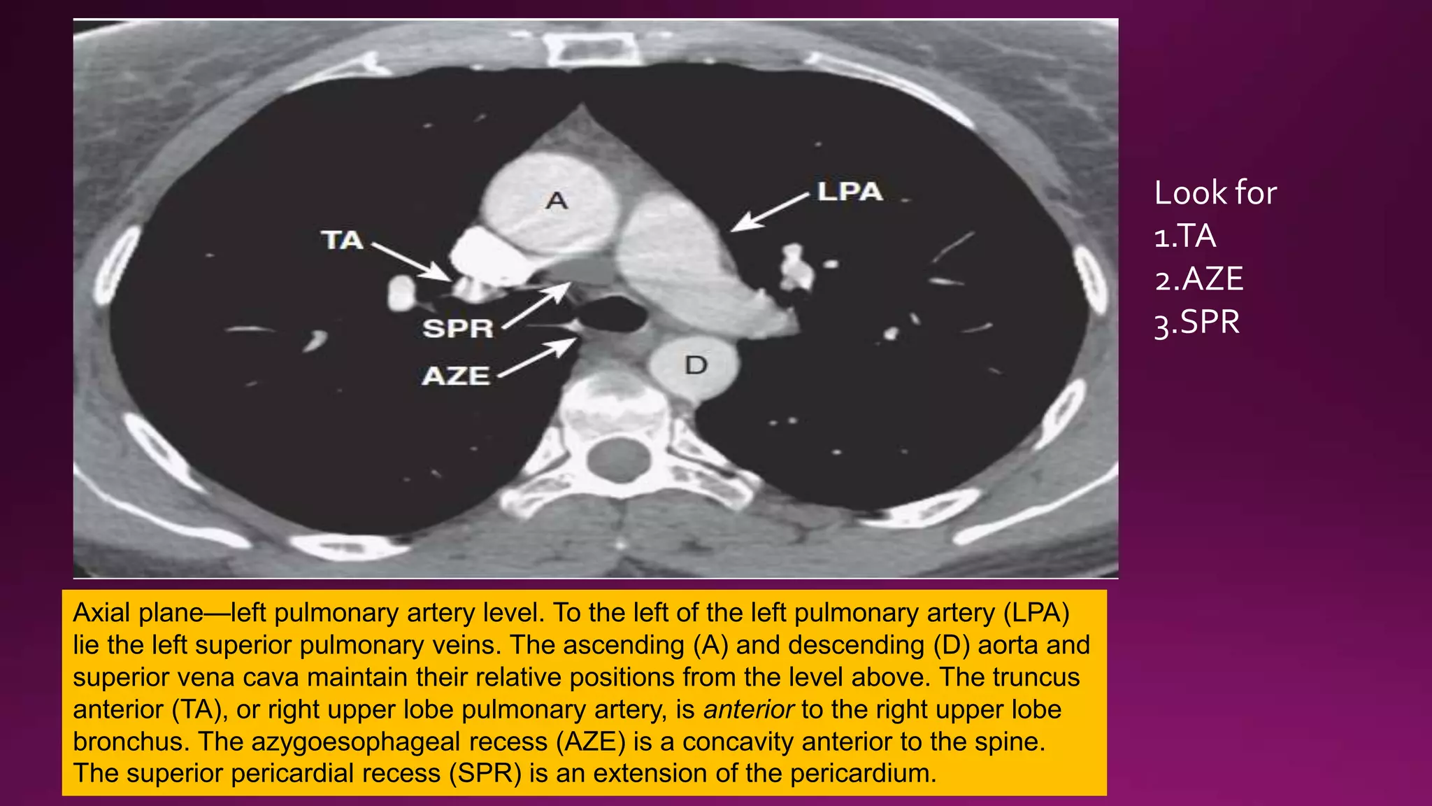 Radiological anatomy of mediastinum | PPTX