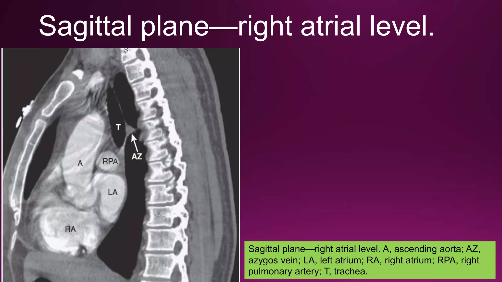 Radiological anatomy of mediastinum | PPTX