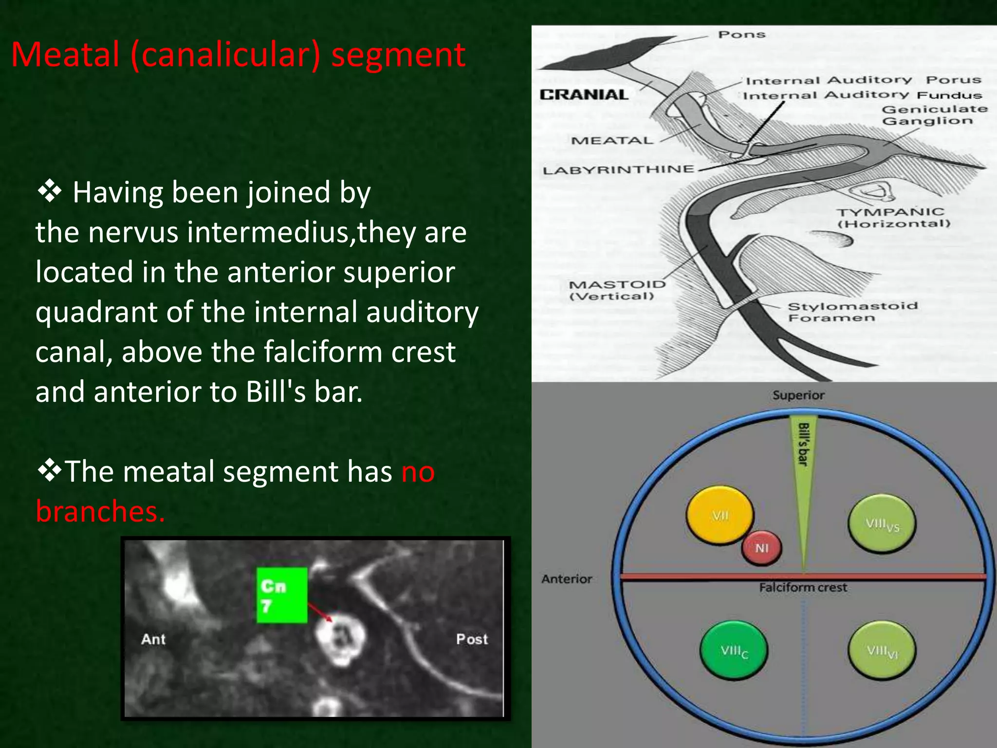 Meatal (canalicular) segment
 Having been joined by
the nervus intermedius,they are
located in the anterior superior
quadrant of the internal auditory
canal, above the falciform crest
and anterior to Bill's bar.
The meatal segment has no
branches.
 