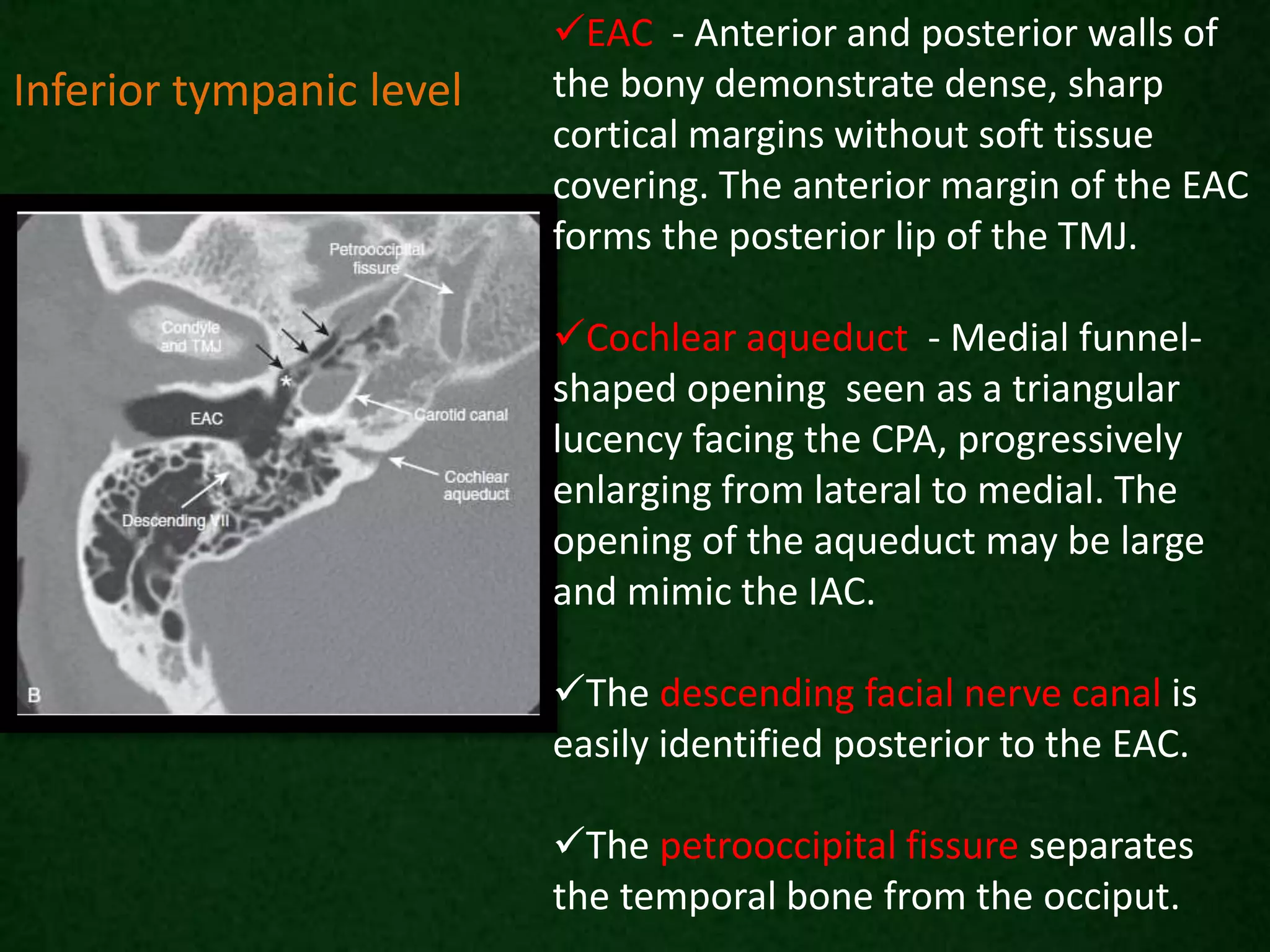 EAC - Anterior and posterior walls of
the bony demonstrate dense, sharp
cortical margins without soft tissue
covering. The anterior margin of the EAC
forms the posterior lip of the TMJ.
Cochlear aqueduct - Medial funnel-
shaped opening seen as a triangular
lucency facing the CPA, progressively
enlarging from lateral to medial. The
opening of the aqueduct may be large
and mimic the IAC.
The descending facial nerve canal is
easily identified posterior to the EAC.
The petrooccipital fissure separates
the temporal bone from the occiput.
Inferior tympanic level
 