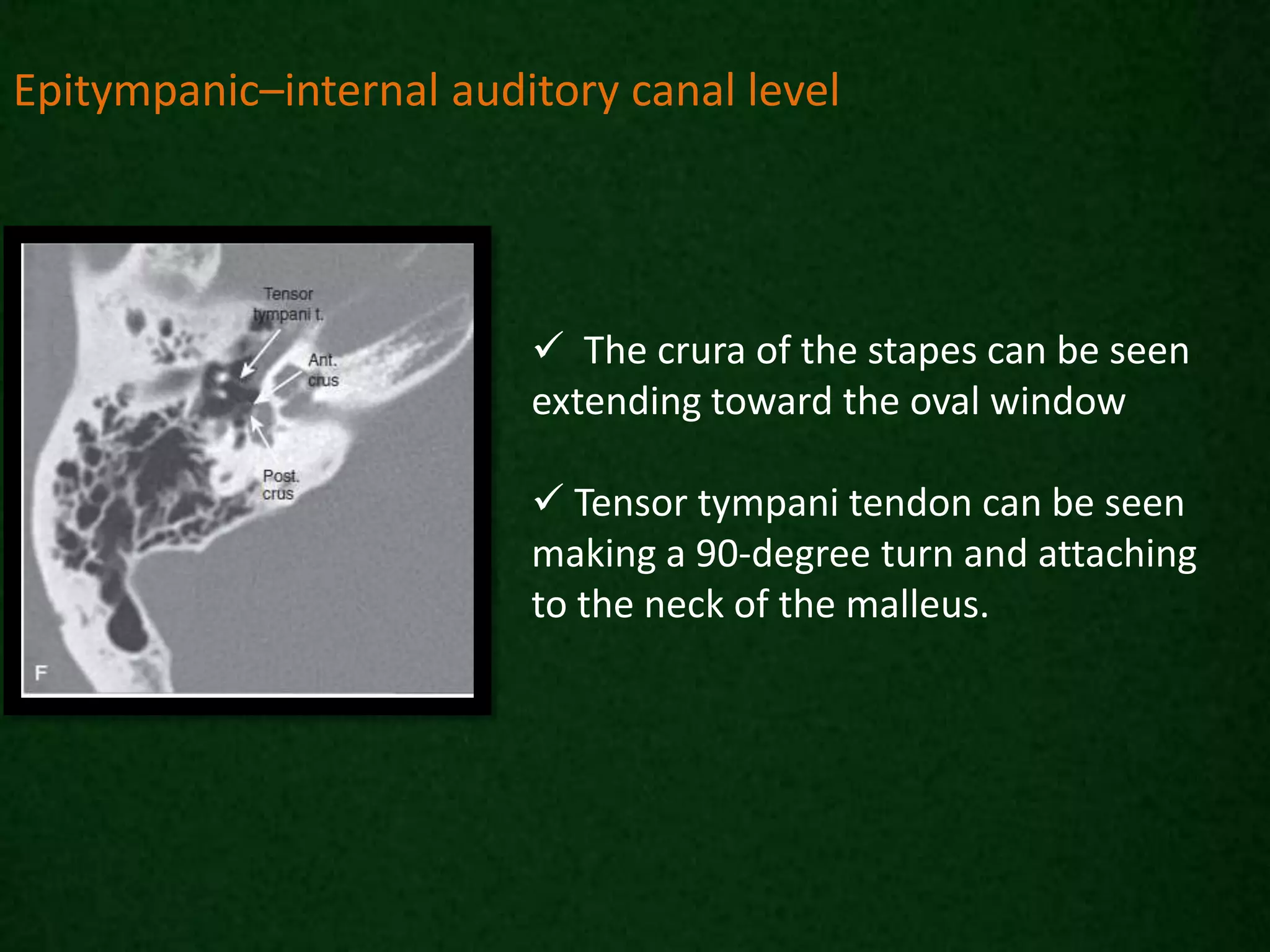  The crura of the stapes can be seen
extending toward the oval window
 Tensor tympani tendon can be seen
making a 90-degree turn and attaching
to the neck of the malleus.
Epitympanic–internal auditory canal level
 