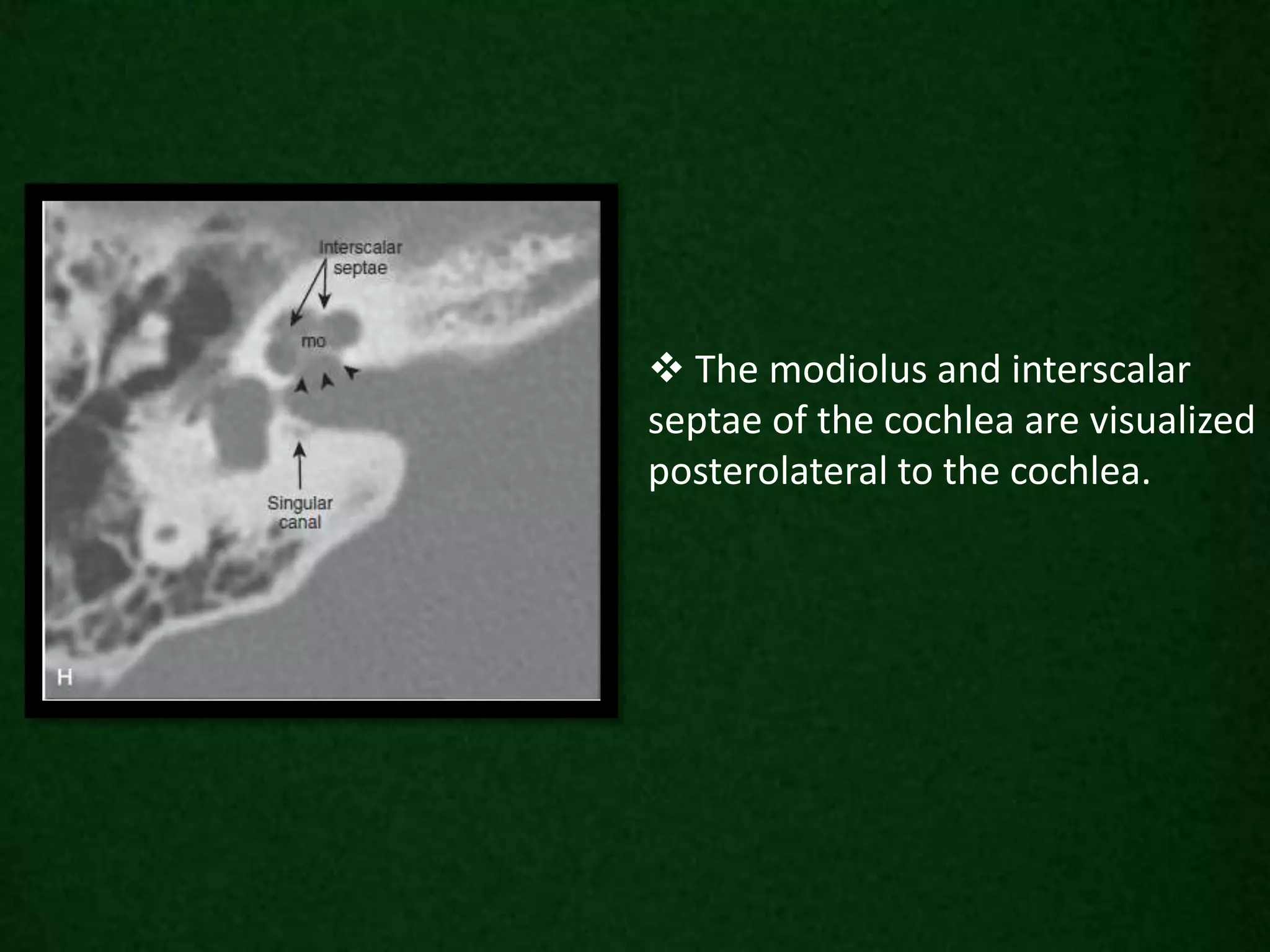  The modiolus and interscalar
septae of the cochlea are visualized
posterolateral to the cochlea.
 