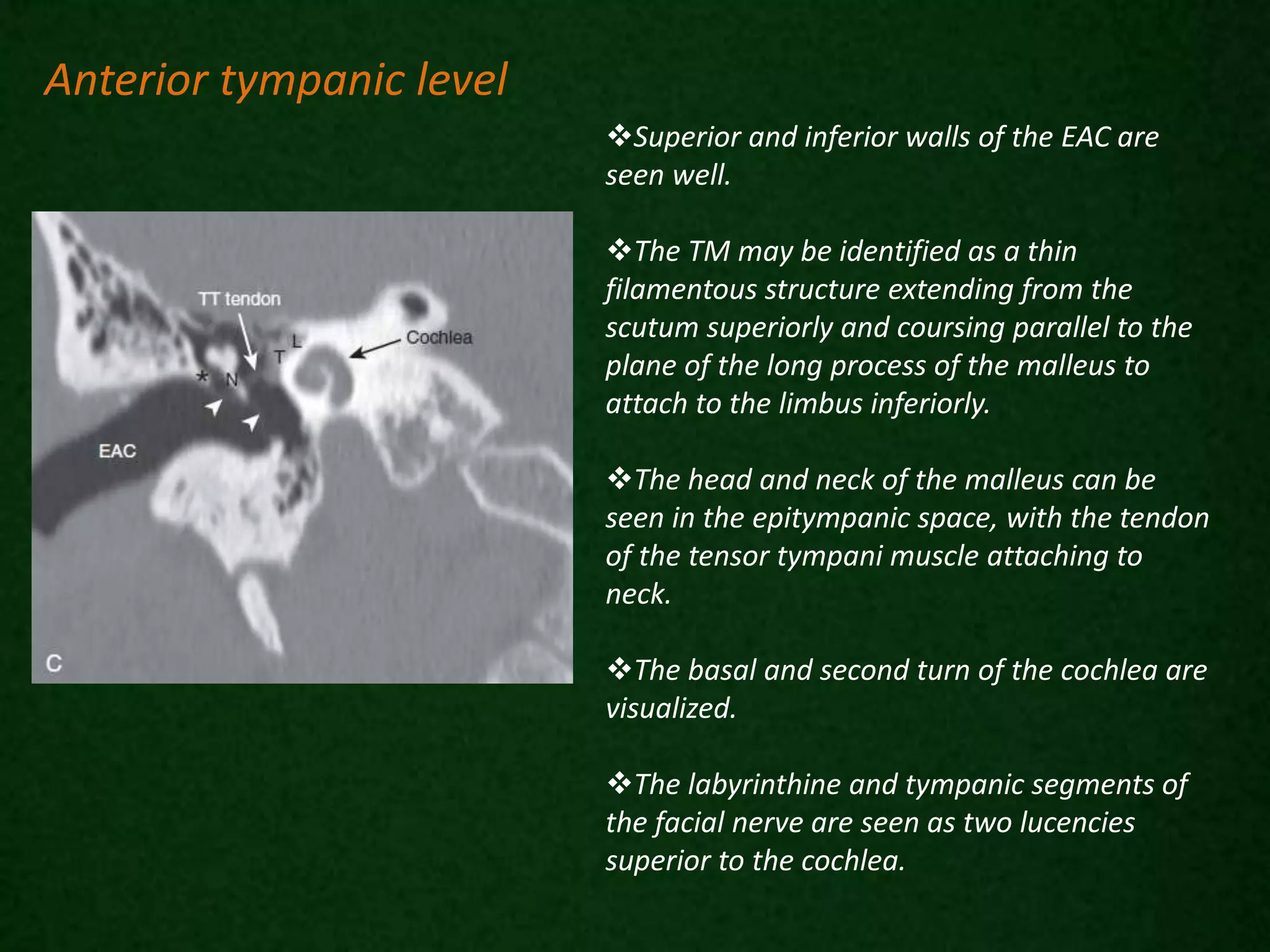Superior and inferior walls of the EAC are
seen well.
The TM may be identified as a thin
filamentous structure extending from the
scutum superiorly and coursing parallel to the
plane of the long process of the malleus to
attach to the limbus inferiorly.
The head and neck of the malleus can be
seen in the epitympanic space, with the tendon
of the tensor tympani muscle attaching to
neck.
The basal and second turn of the cochlea are
visualized.
The labyrinthine and tympanic segments of
the facial nerve are seen as two lucencies
superior to the cochlea.
Anterior tympanic level
 
