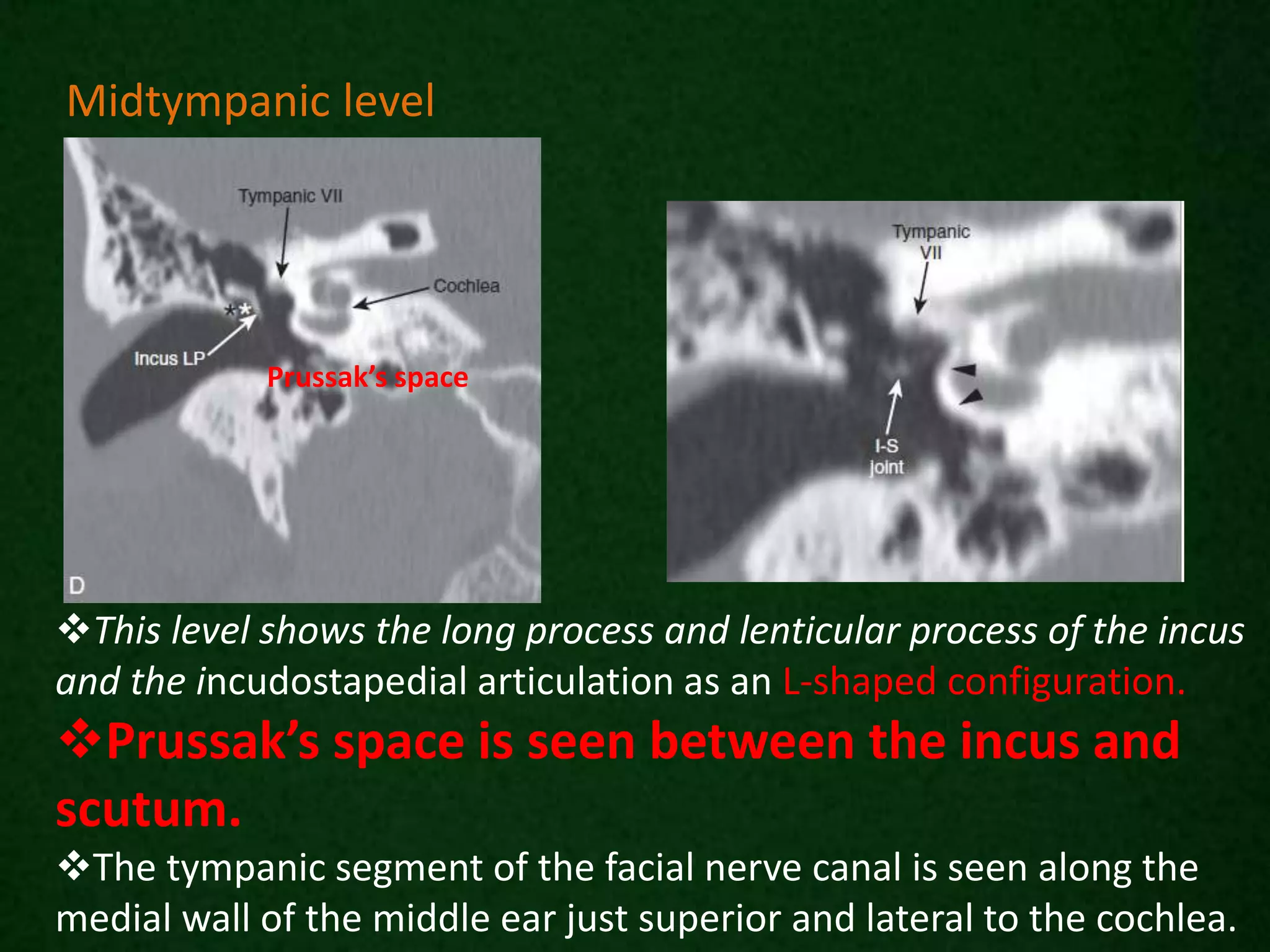 This level shows the long process and lenticular process of the incus
and the incudostapedial articulation as an L-shaped configuration.
Prussak’s space is seen between the incus and
scutum.
The tympanic segment of the facial nerve canal is seen along the
medial wall of the middle ear just superior and lateral to the cochlea.
Midtympanic level
Prussak’s space
 