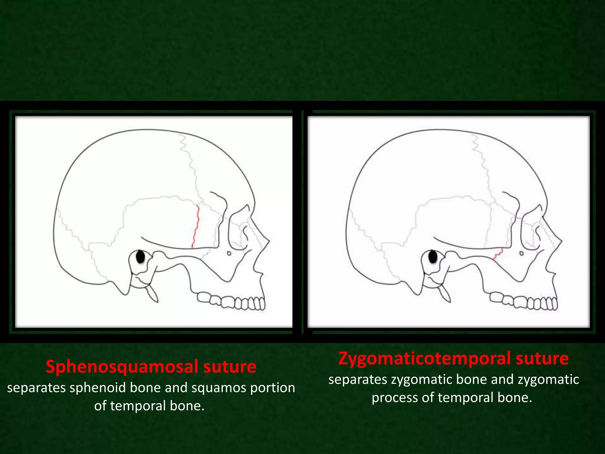 Sphenosquamosal suture
separates sphenoid bone and squamos portion
of temporal bone.
Zygomaticotemporal suture
separates zygomatic bone and zygomatic
process of temporal bone.
 