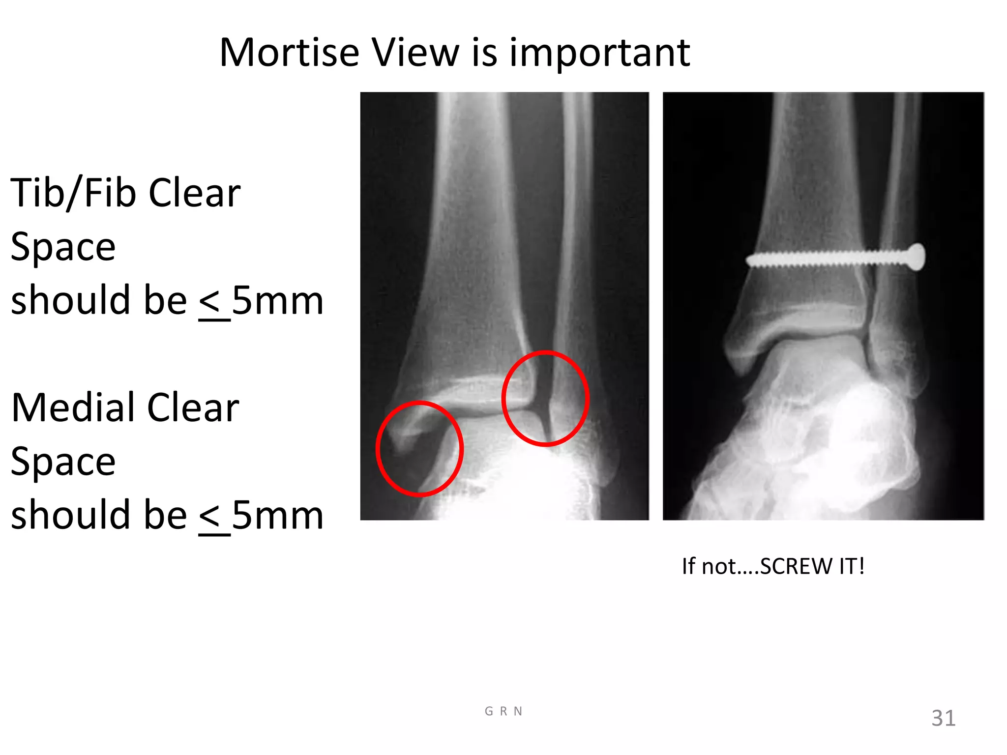 Radiological anatomy of the lower limb r | PDF