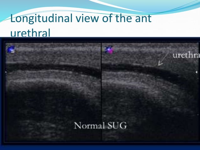 Radiological anatomy of the male urethra and techniques of imaging ...