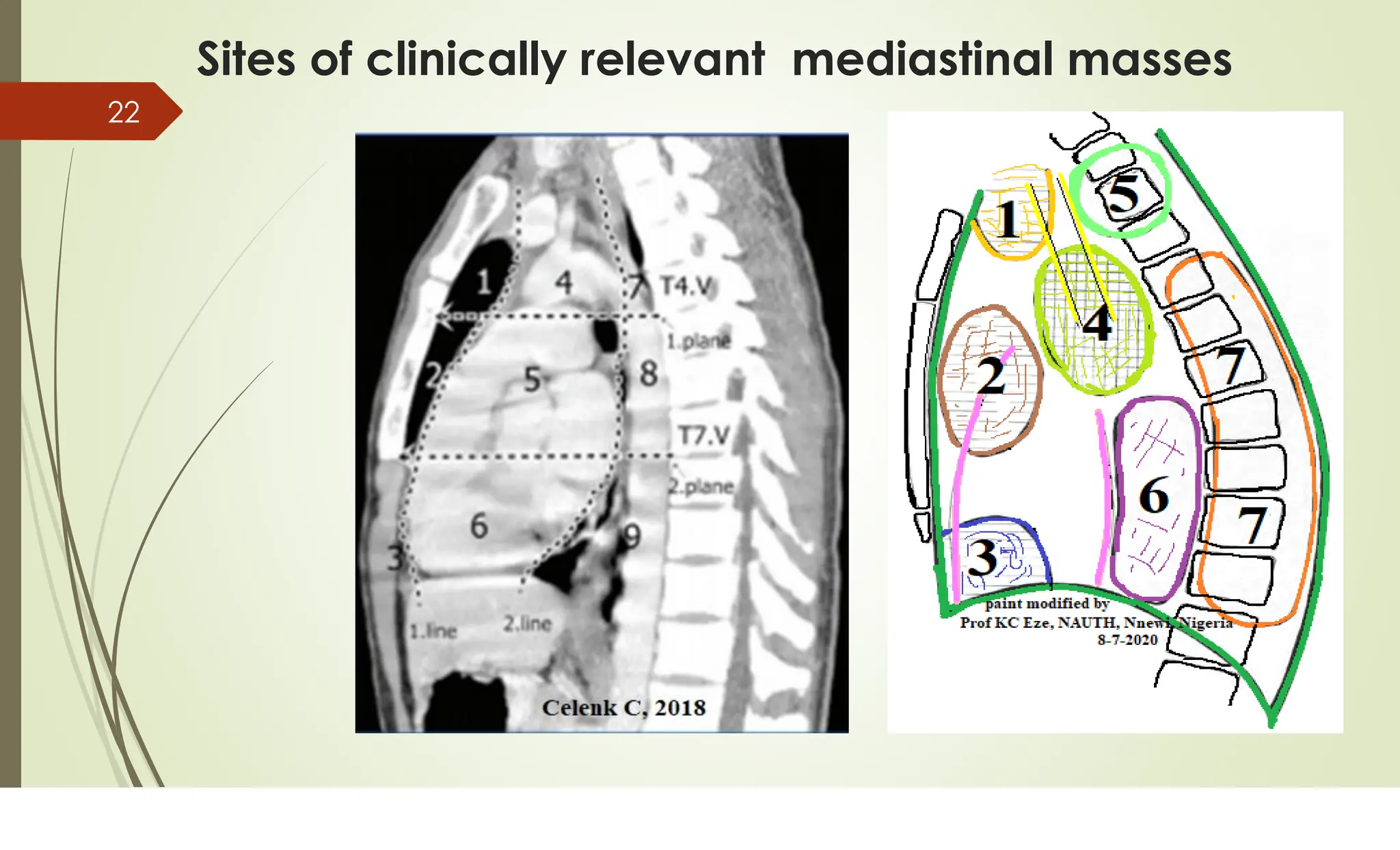 RADIOLOGICAL ANATOMY OF THE MEDIASTINUM.PDF