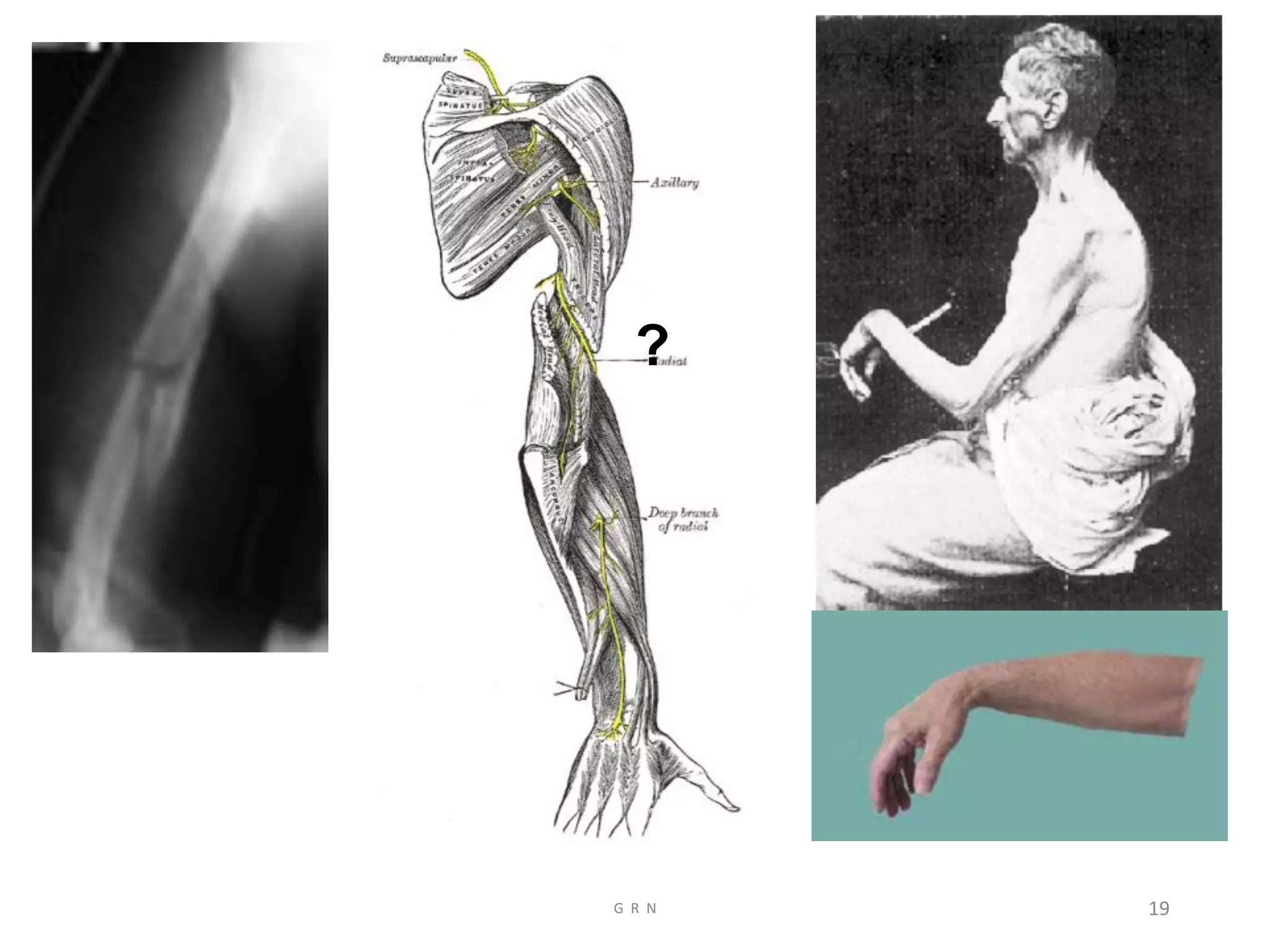 Radiological anatomy of the upper limb r | PDF