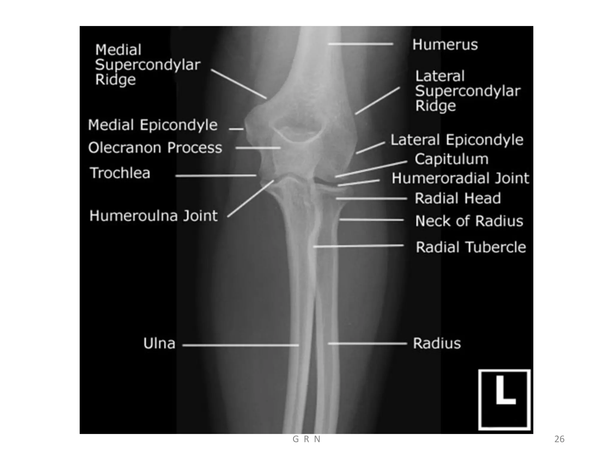 Radiological anatomy of the upper limb r | PDF