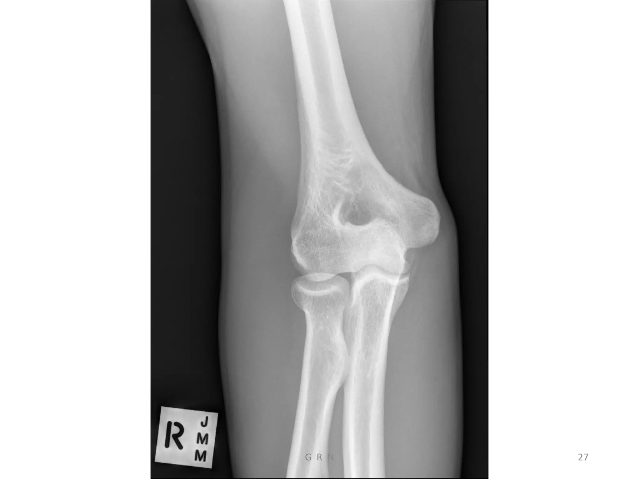 Radiological anatomy of the upper limb r | PDF