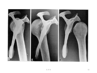 Bilaterally Upper Rails Radiological anatomy of the upper limb r | PDF